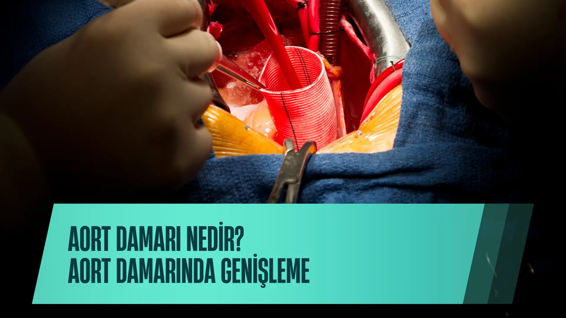 Aort Damarı nedir Aort Damarında Genişleme