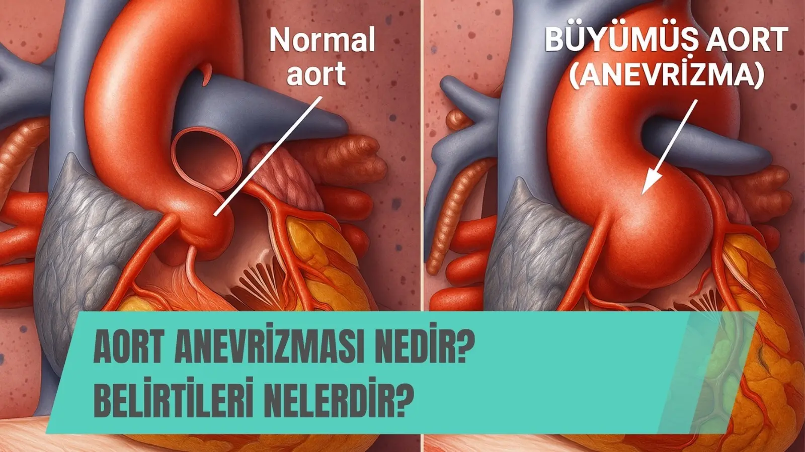 aort anevrizması nedir belirtileri nelerdir
