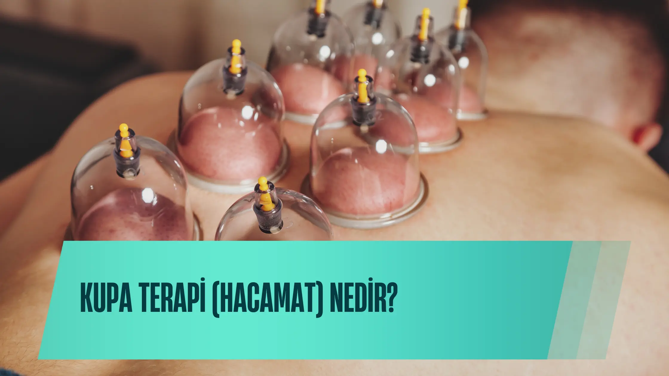 Kupa Terapi (Hacamat) Nedir? Faydaları, Uygulama Alanları ve Dikkat Edilmesi Gerekenler