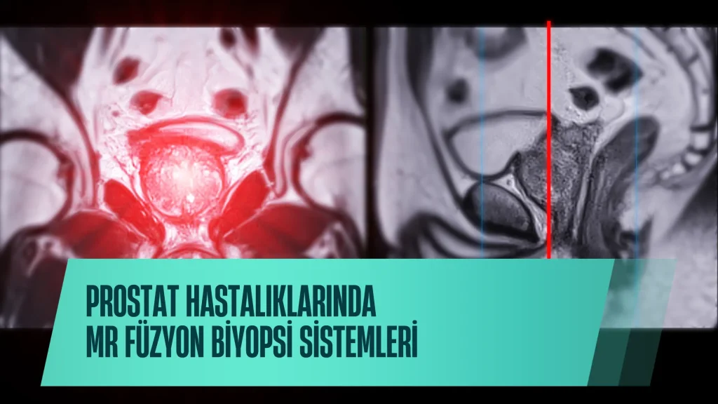 MR Füzyon Biyopsi Sistemleri ve Prostat Hastalıklarında Modern Yaklaşımlar