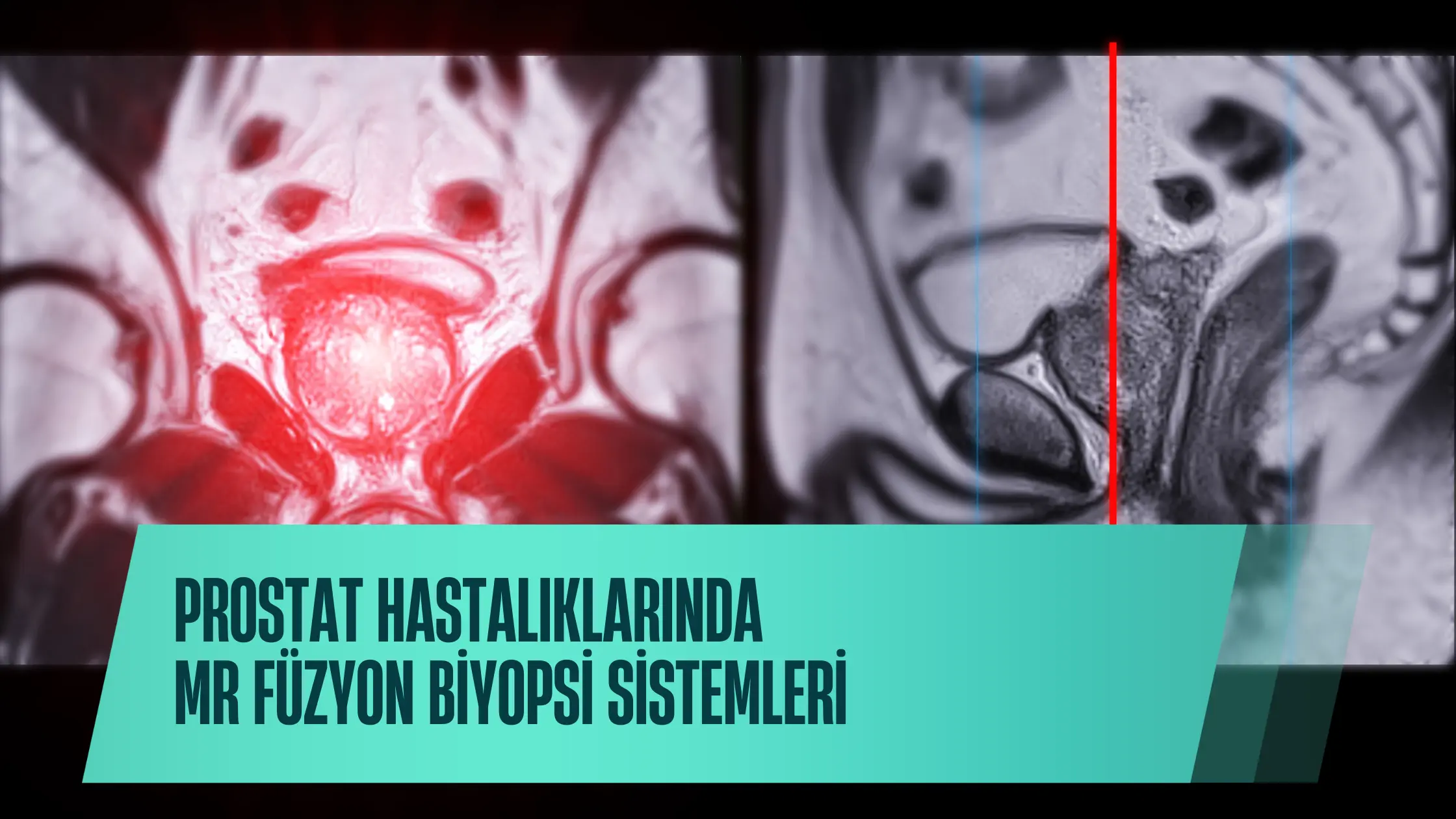 MR Füzyon Biyopsi Sistemleri ve Prostat Hastalıklarında Modern Yaklaşımlar
