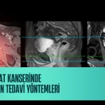 Prostat Kanserinde Modern Tedavi Yöntemleri