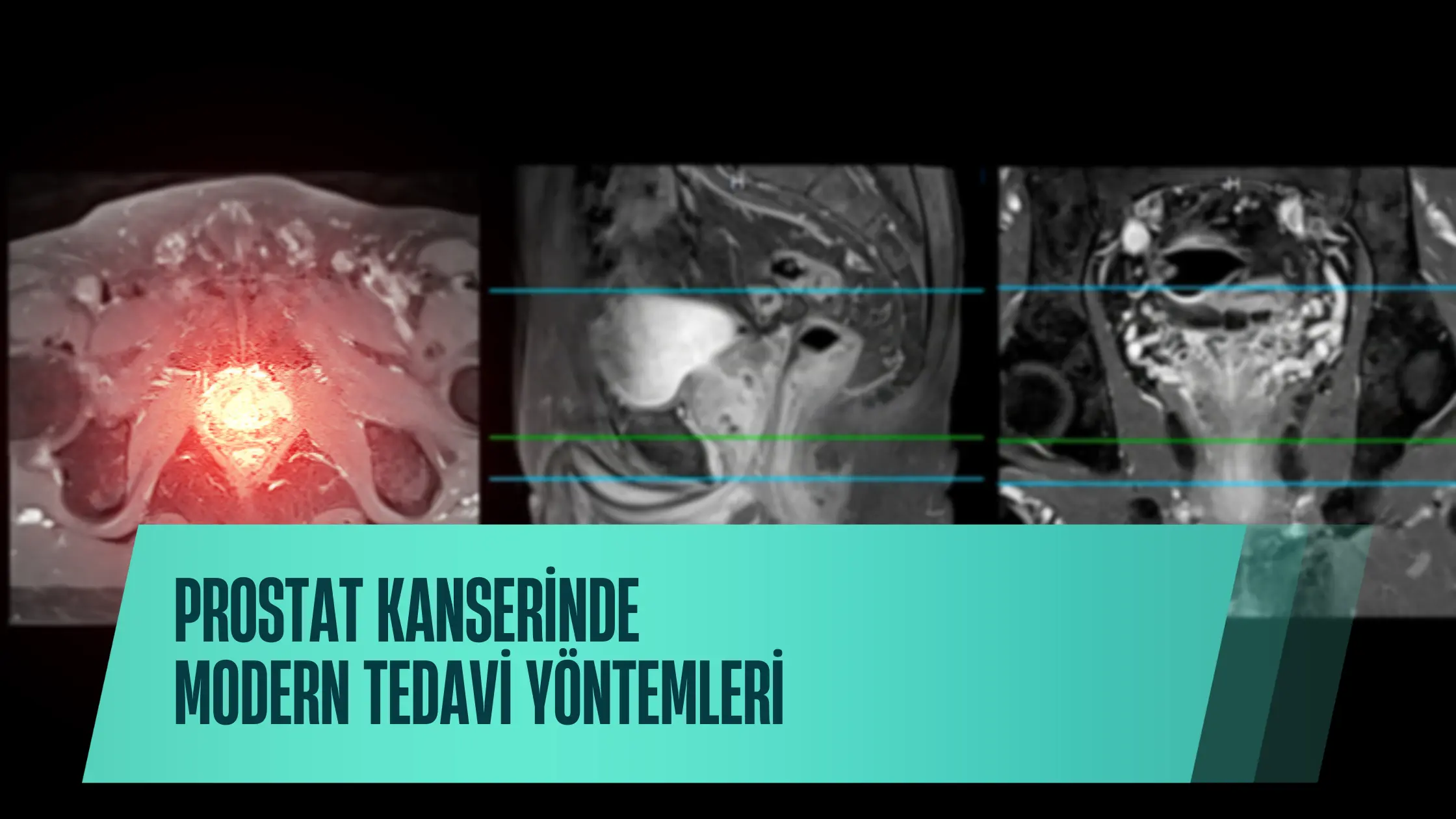 Prostat Kanserinde Modern Tedavi Yöntemleri