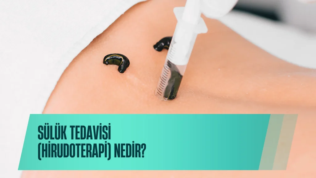 Sülük Tedavisi (Hirudoterapi) Nedir?