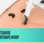 Sülük Tedavisi (Hirudoterapi) Nedir