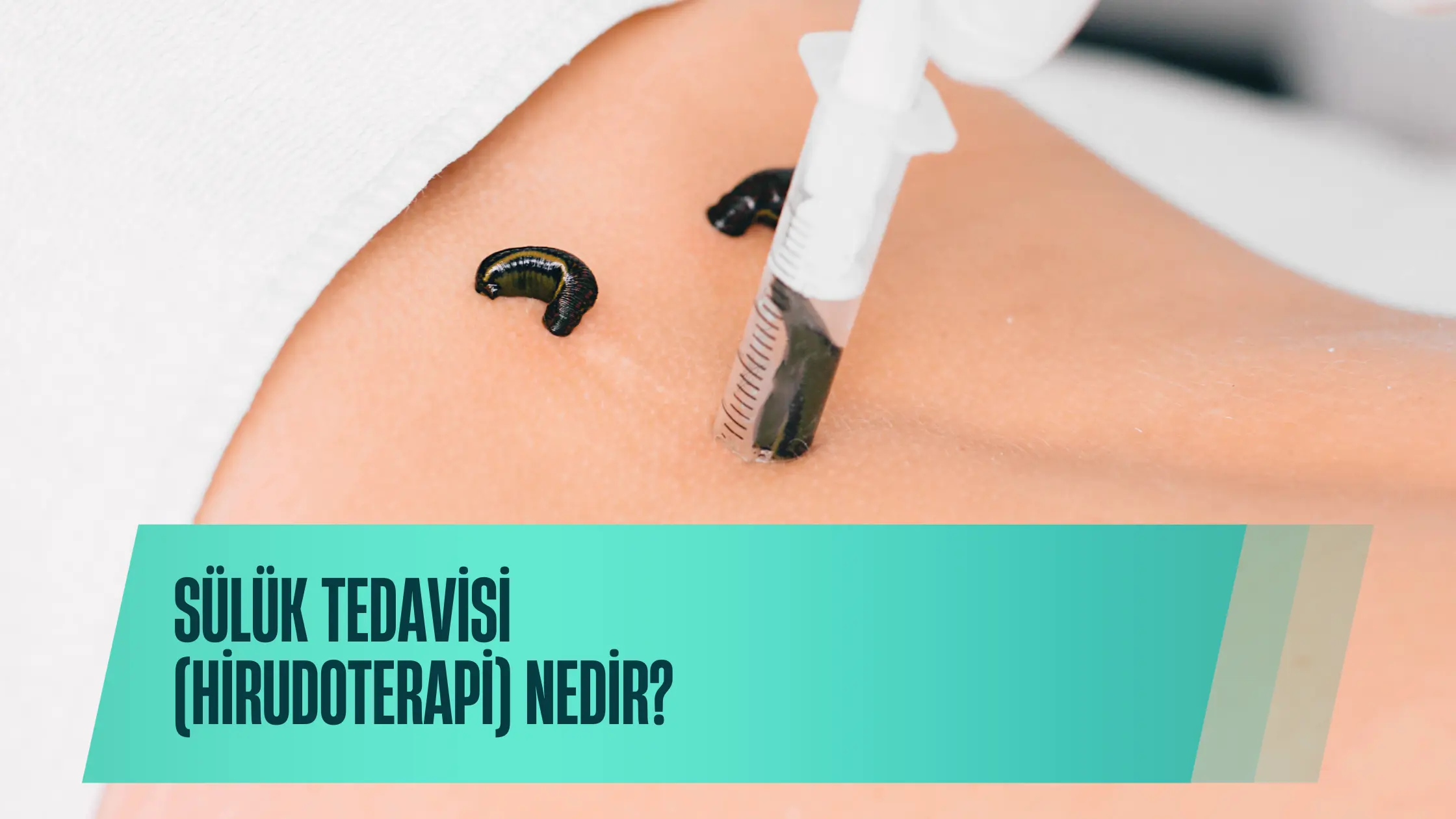 Sülük Tedavisi (Hirudoterapi) Nedir?