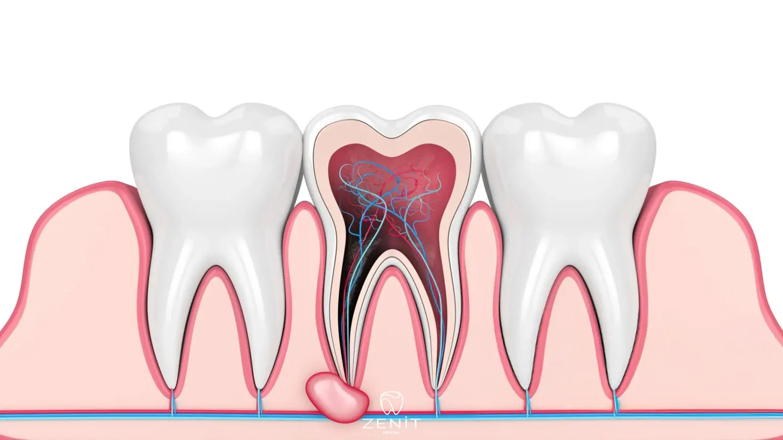 Apikal Rezeksiyon Nedir? Ne Zaman Yapılır, İyileşme Süreci Nasıldır?