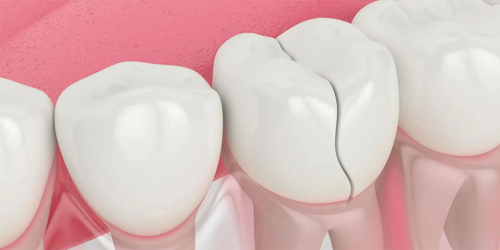 Diş Travması Nedir? Tanı, Tedavi, Splint ve Uzun Dönem Takip