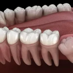 Gömülü Diş Çekimi Nedir