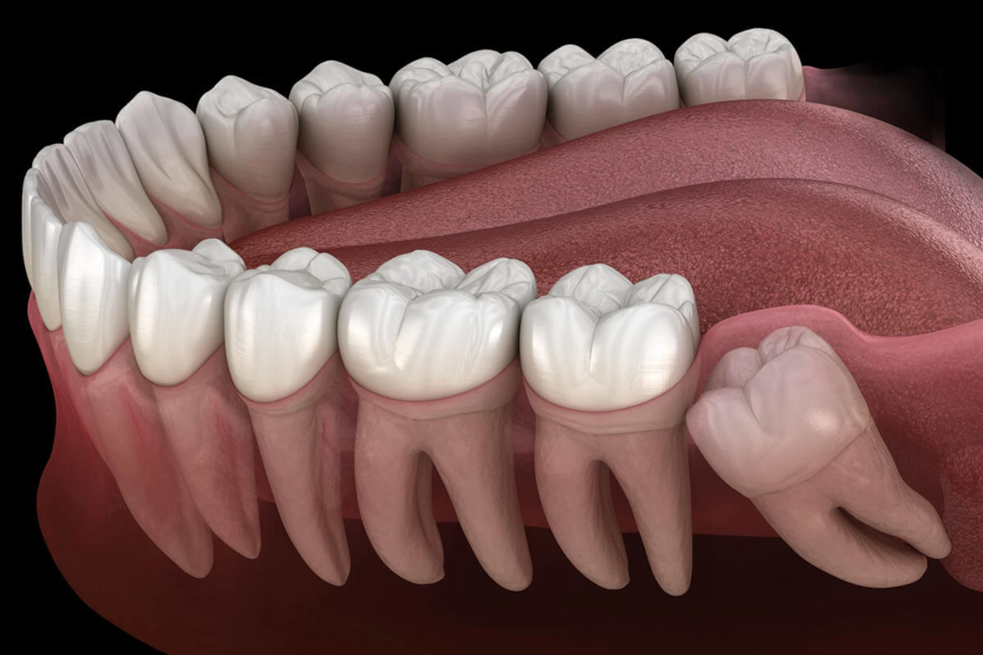 Gömülü Diş Çekimi Nedir? Ne Zaman Gerekir, İyileşme Süreci Nasıldır?