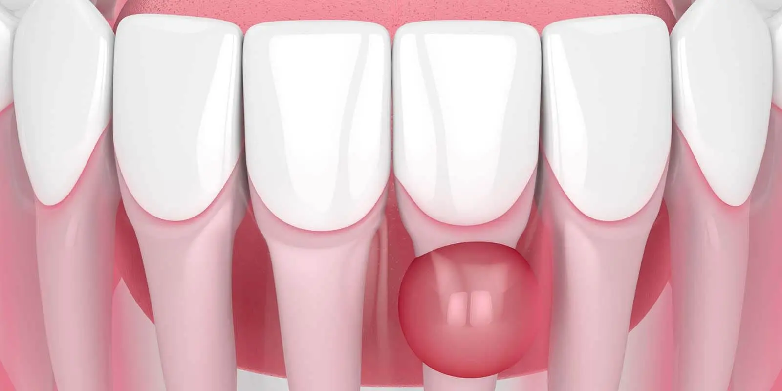 Kist Dekompresyonu Nedir? Çene Kistlerinde Ne Zaman Yapılır?