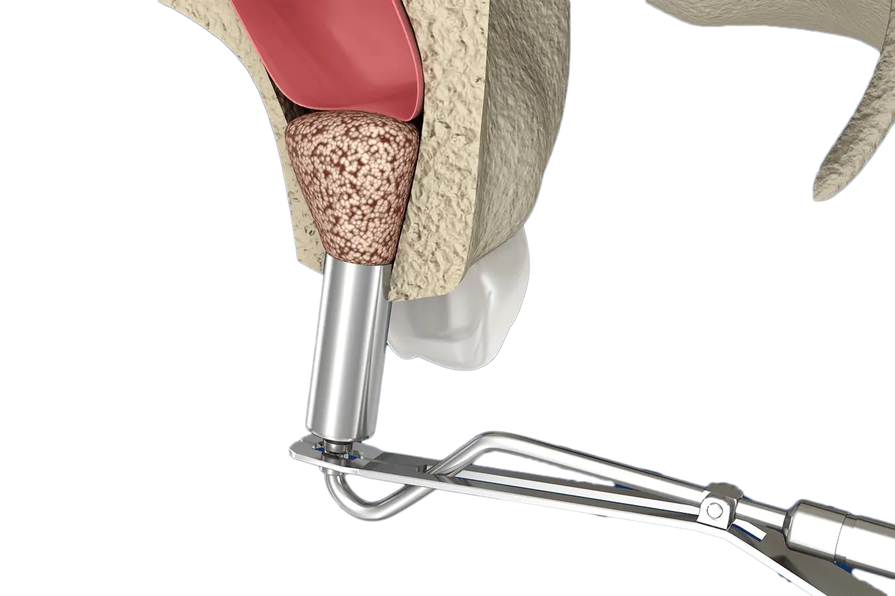 Otojen Kemik Grefti Nedir? İmplant Öncesi Çene Kemiği Artırımı ve İyileşme