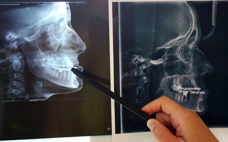 Bilateral Sagital Split Osteotomi (BSSO) Nedir? Süreç, İyileşme ve Riskler