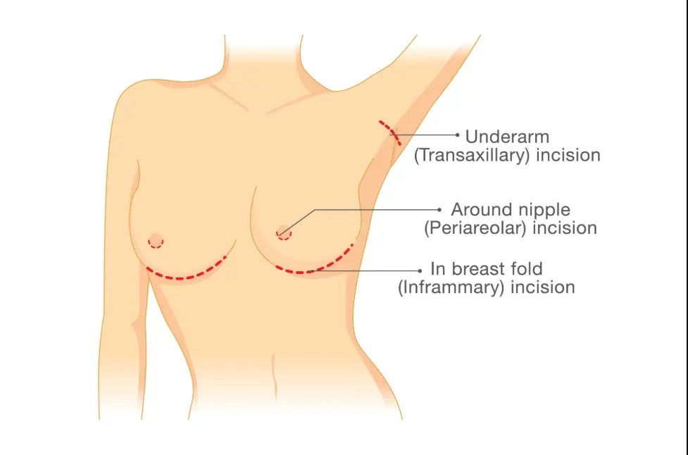 meme büyütme ameliyatı