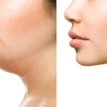 Gıdı Liposakşını (Çene Altı Liposuction) Nedir