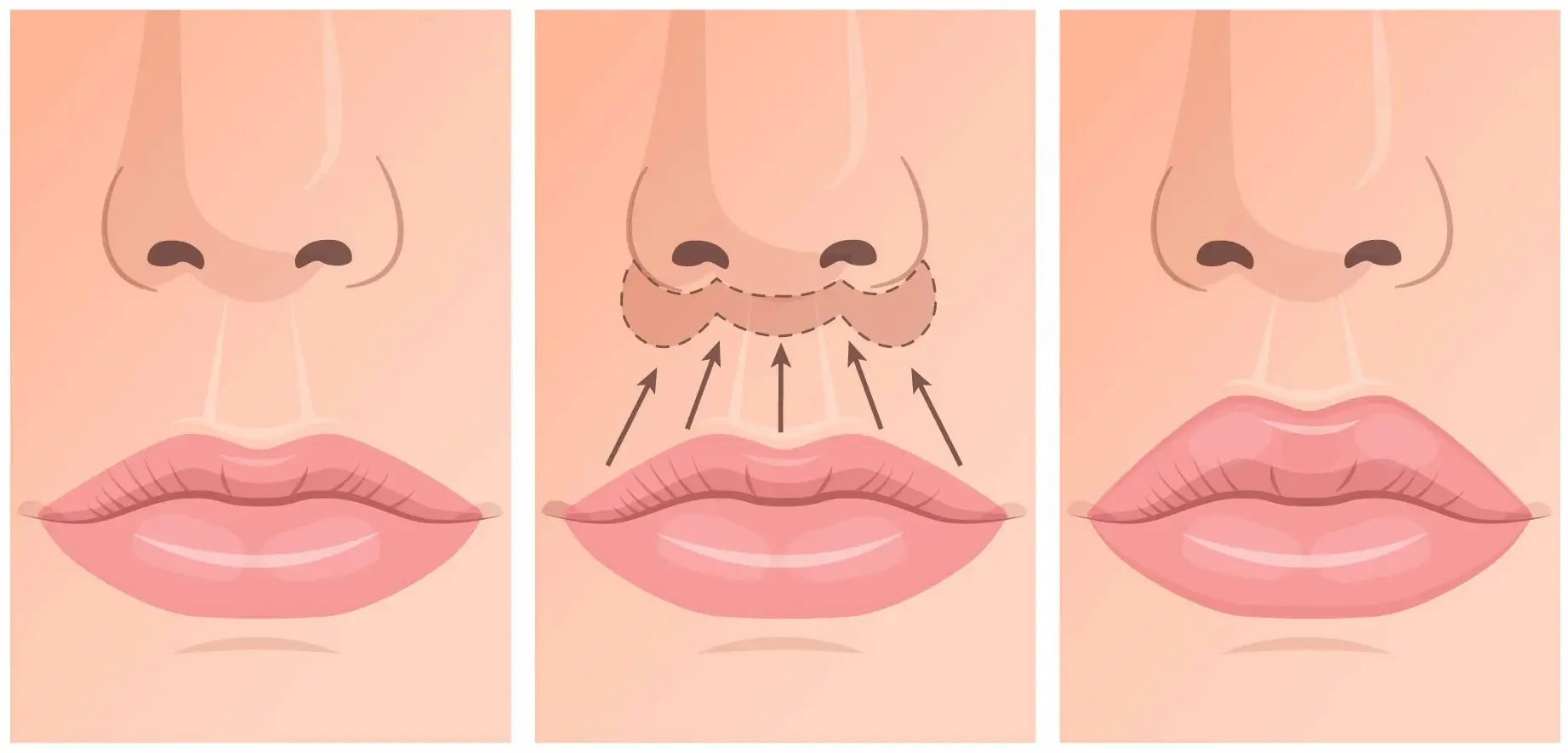 Lip Lift (Üst Dudak Kaldırma) Ameliyatı Nedir?