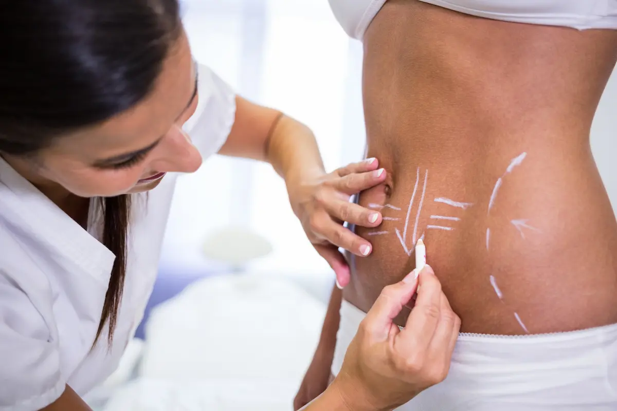 Liposakşın (Liposuction) Nedir?
